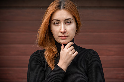 Young adult woman presenting acne on her face